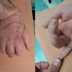 Амурчанину собрали новый палец из двух других после травмы циркулярной пилой